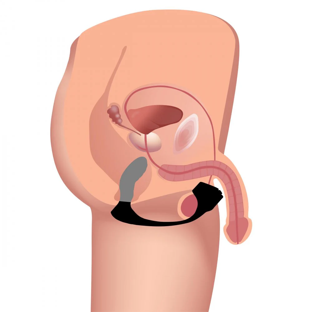 7X Silicone Prostate Plug w- Ball Stretcher & Remote by trinity vibes - Image 3